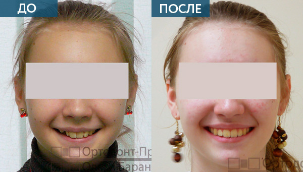 исправление дистального прикуса у взрослых