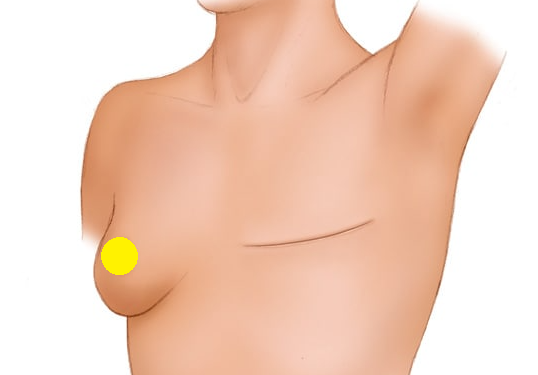 Косметический результат после мастэктомии в классическом её варианте