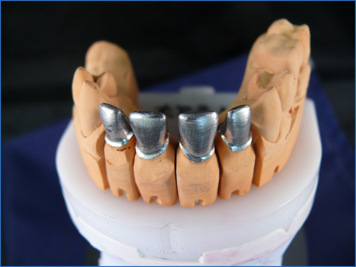 Каркас металлокерамических коронок