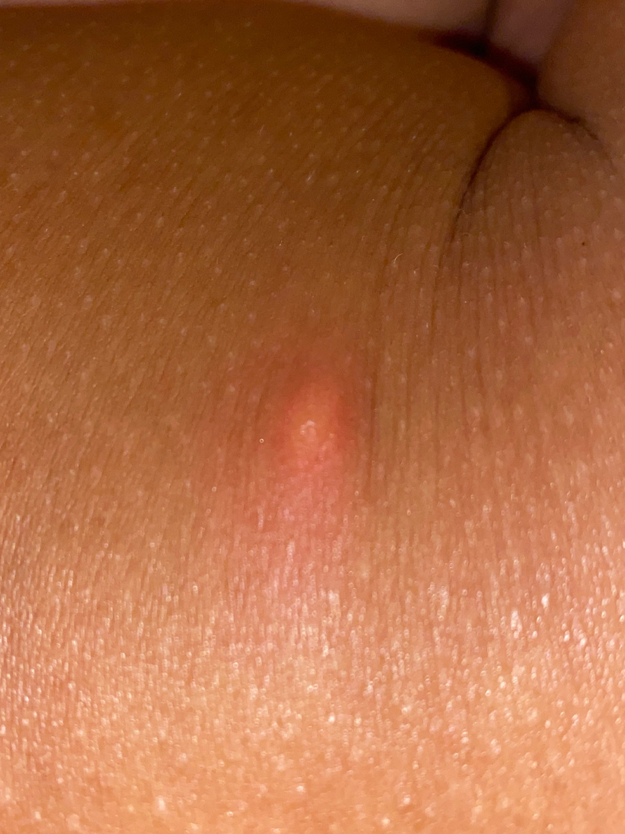 Укус второй день 🤣