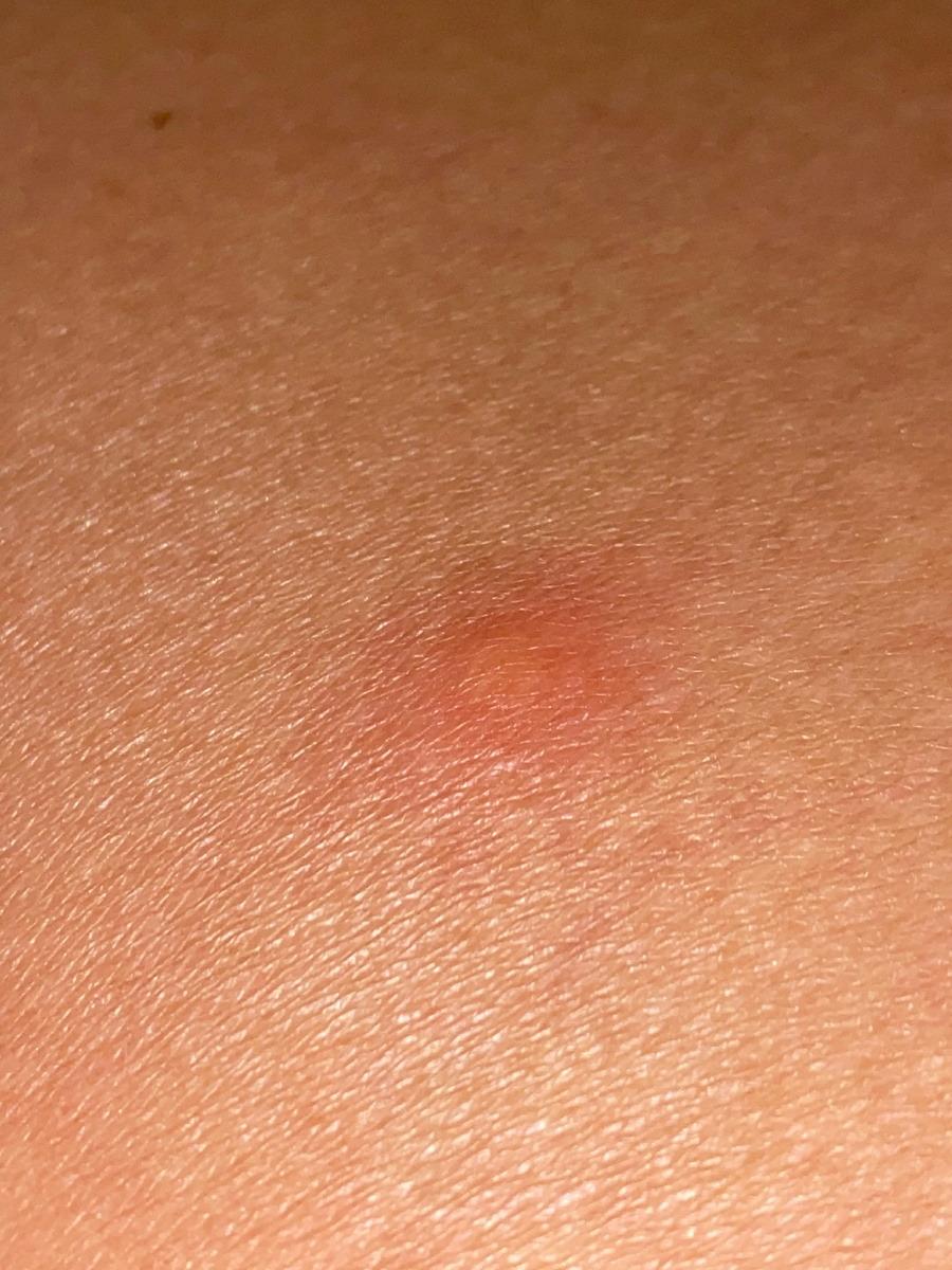 Фото укуса 1й день 