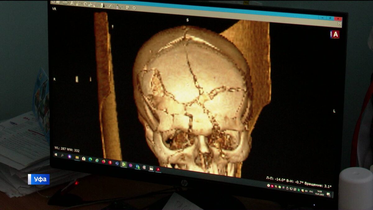    В Уфе прооперировали подростка, который впал в кому из-за попавшего в голову фейерверка
