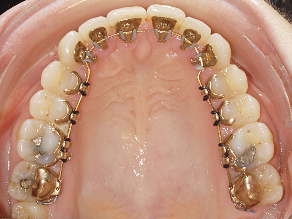 Лингвальные брекеты.