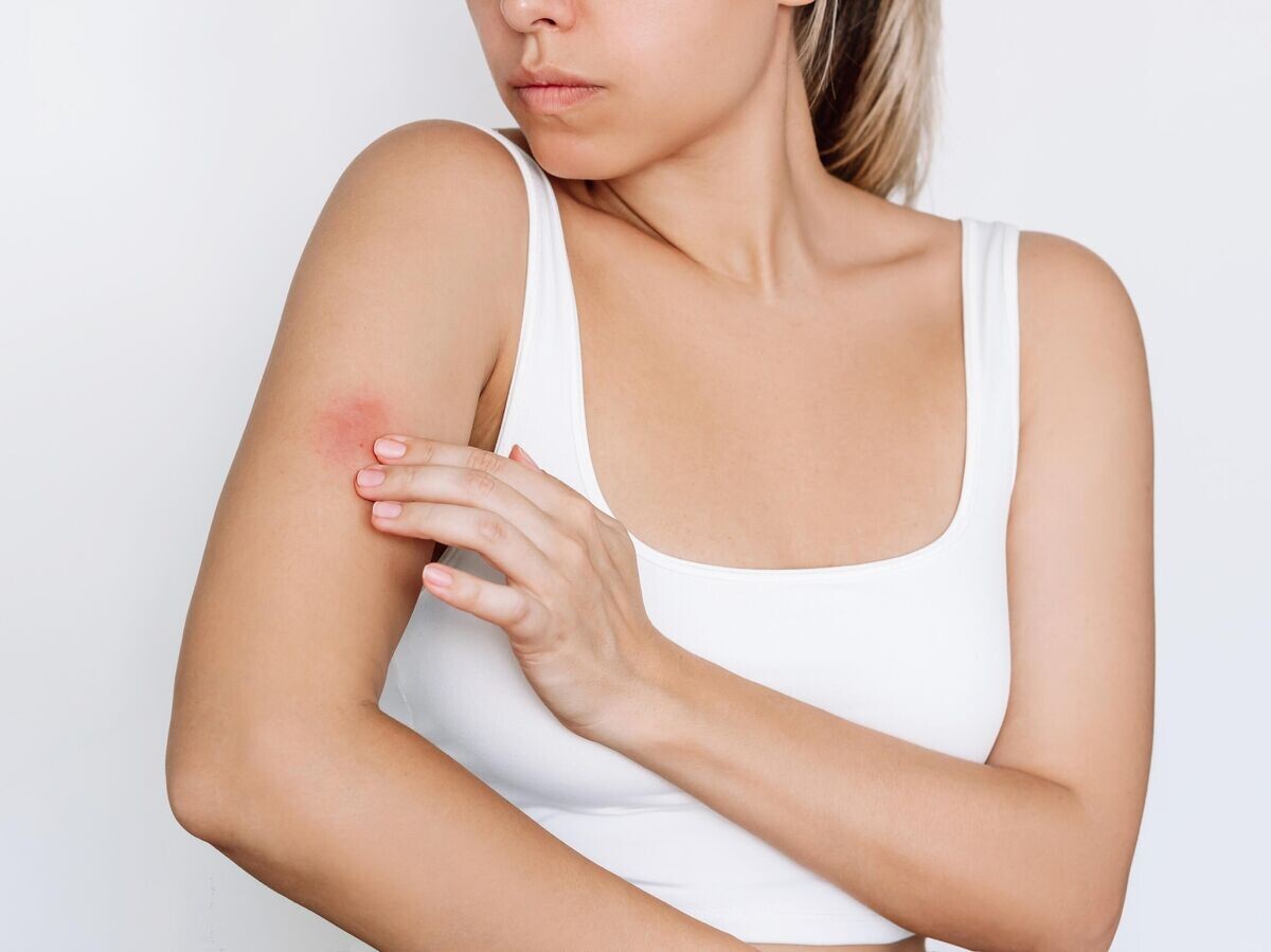    Кожное заболевание© iStock.com / Marina Demeshko