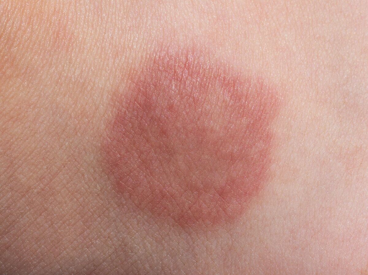    Розовый лишай© iStock.com / gutaper