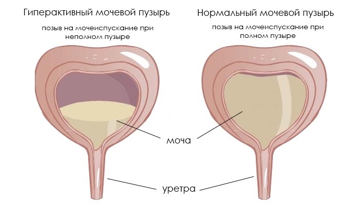 Гиперактивный мочевой пузырь
