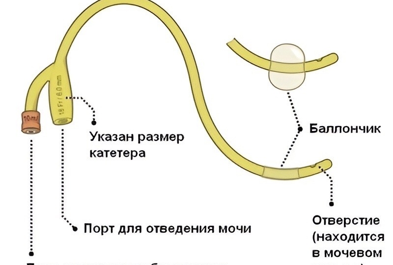 Когда нужно срочно обратиться к врачу пациентам с цистомой?