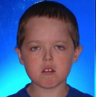 Аденоидный тип лица 