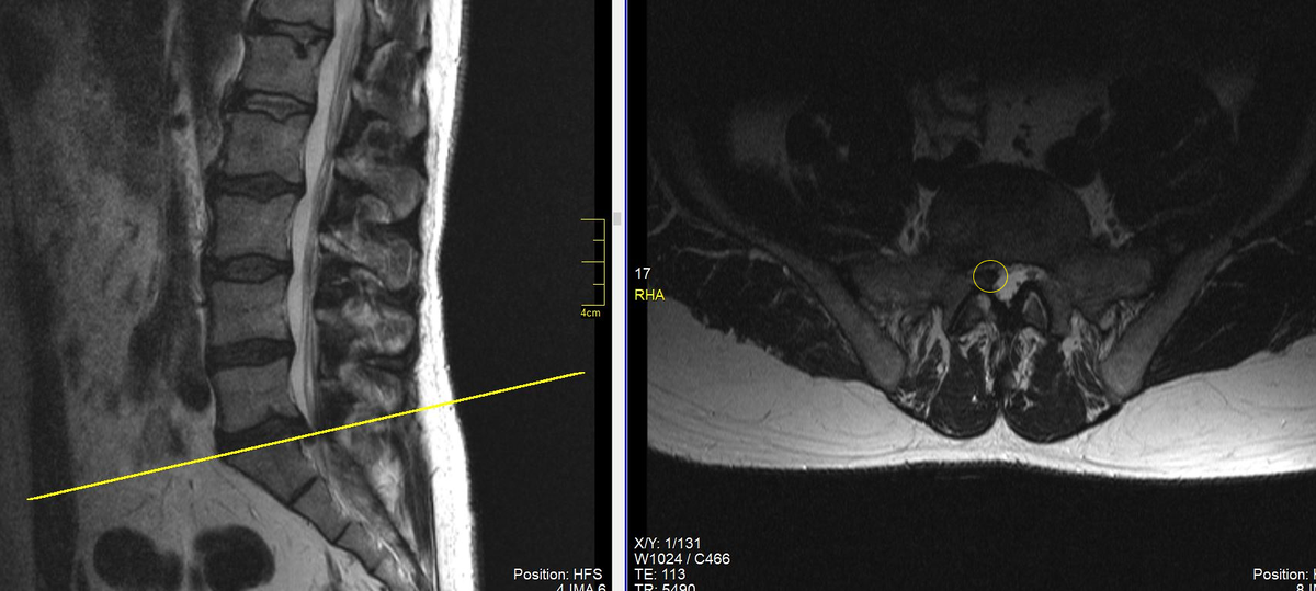 МРТ пояснично-крестцового отдела позвоночника: секвестрированная грыжа межпозвонкового диска между 5 поясничным и 1 крестцовым позвонками с сдавлением нервного корешка справа. Необходима операция. (данные собственного архива). 
