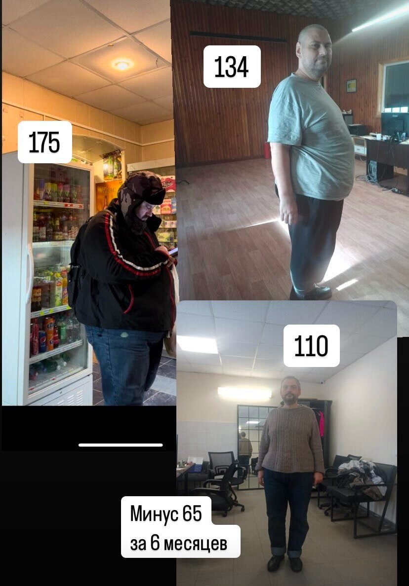 Избавление от ожирения с помощью бариатрической операции