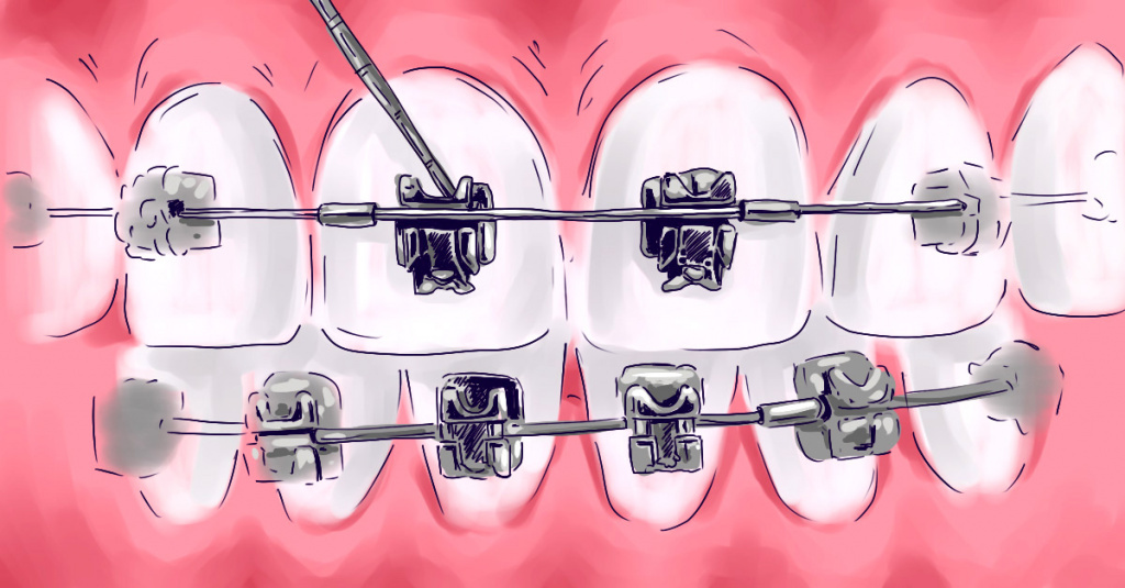 Безлигатуные брекеты.