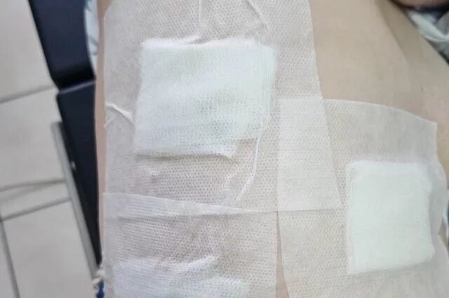    Как в Твери женщина несколько лет жила с иголкой в лёгком?