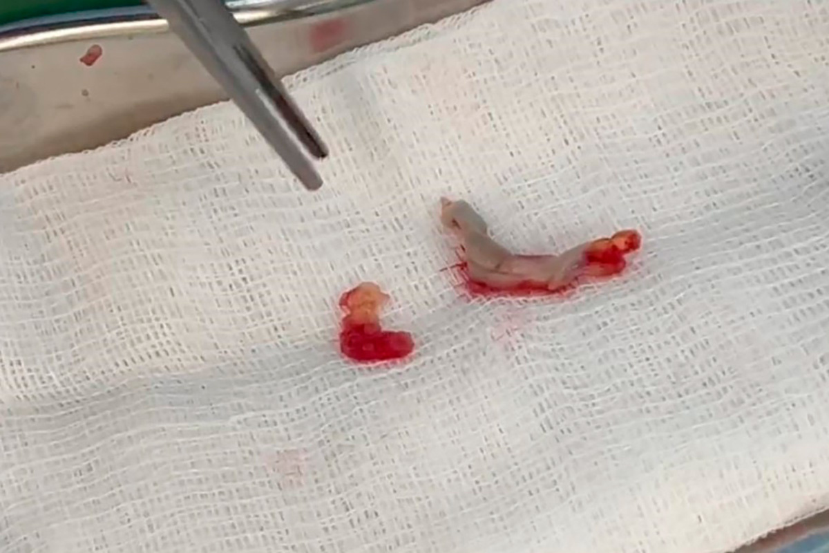 meshalkinclinic / Telegram📷Извлеченный тромб в форме подковы