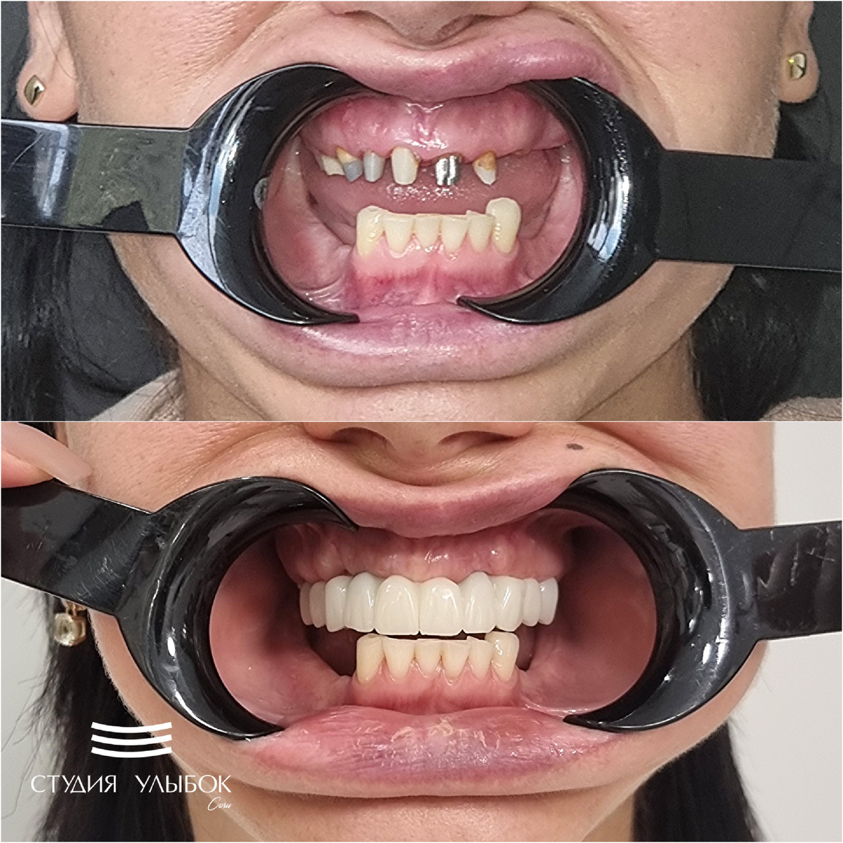 Одномоментное удаление зубов и установка 6 имплантатов под наркозом