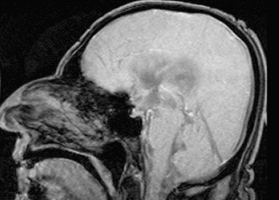 Пульсация спинномозговой жидкости в мозге человека. Во время этой пульсации и идёт очистка от "мусора"