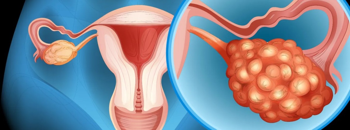 Как определить реакцию на химиотерапию при раке яичников?