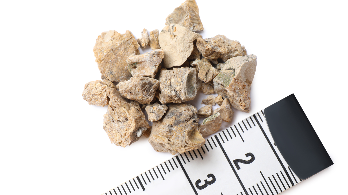 Что урологи делают с камнями из почек после удаления?