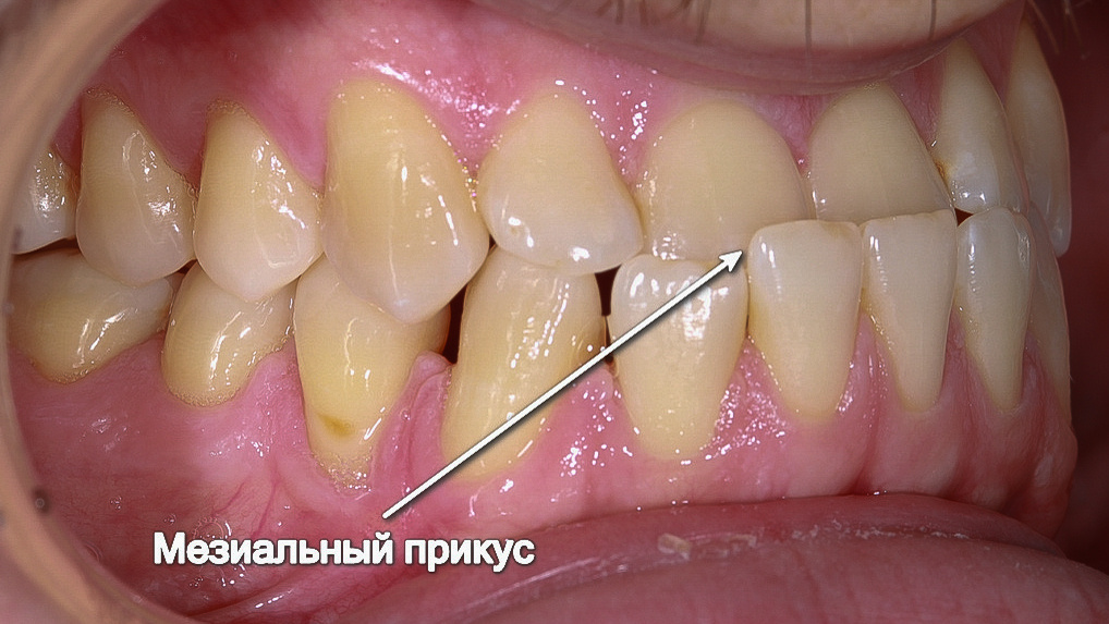 Зубы нижней челюсти перекрывают зубы верхней челюсти