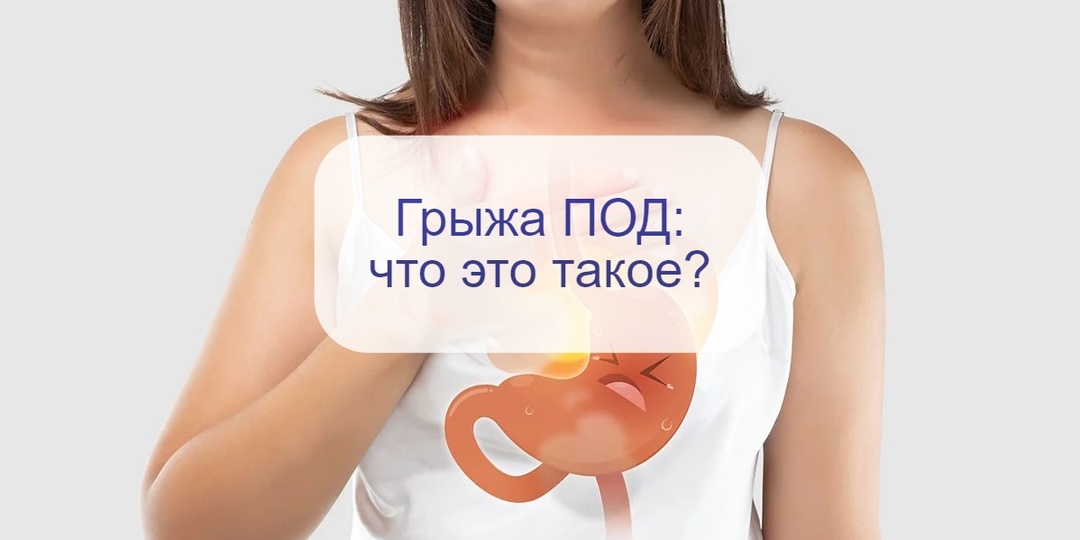 Грыжи бывают разные: иногда даже в диафрагме, и это ведет к отрыжке, изжоге и не только…