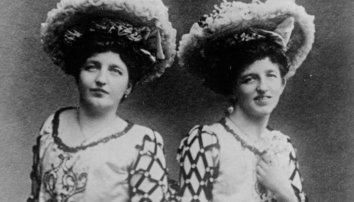 Сиамские близнеы Блажек — Жозефа (слева) и Роза (справа). Фото: woman.ru