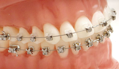 На верхних зубах Damon-3 (эстетическая версия), на нижних Damon-Q.