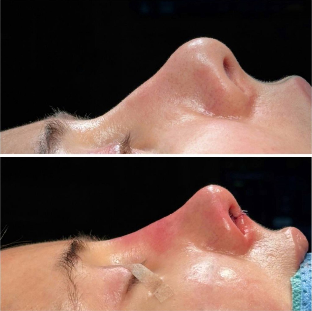 Хирургическая коррекция носа. Ранее выполнена ринопластика в другой клинике. Откорректировали кончик носа, что бы он был менее закругленным, убрали небольшую горбинку, восстановили дыхание.
