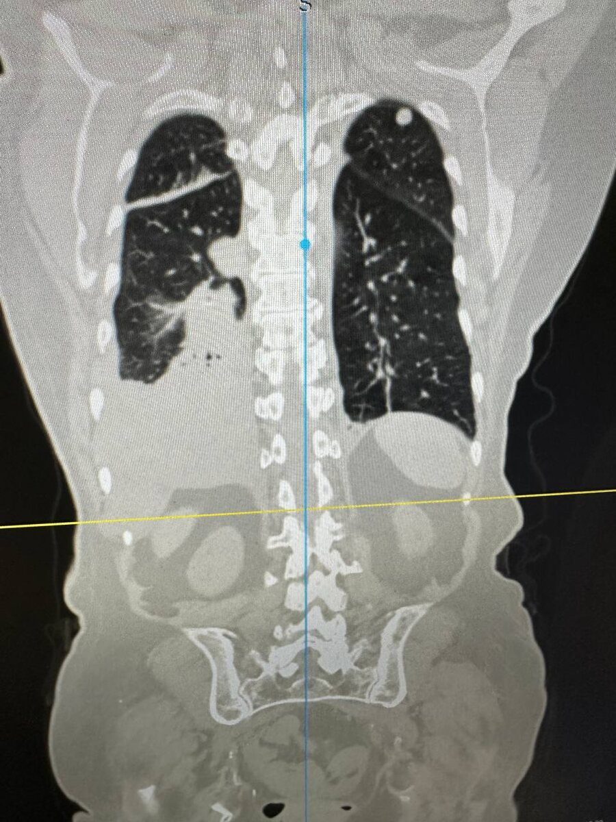 КТ - метастазы в лёгком.
