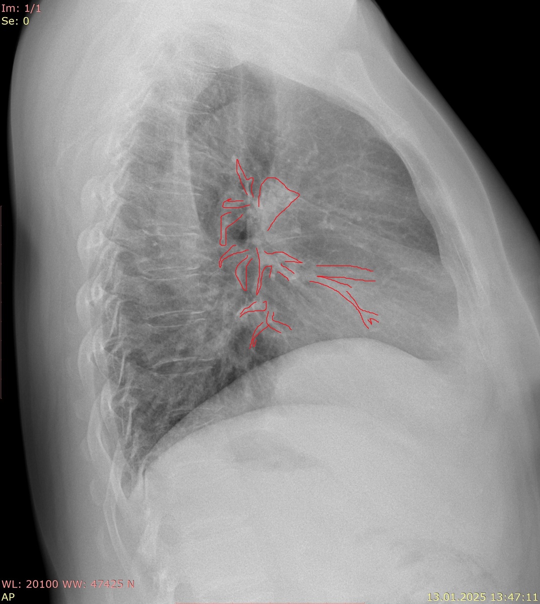 Сосуды легочной артерии.