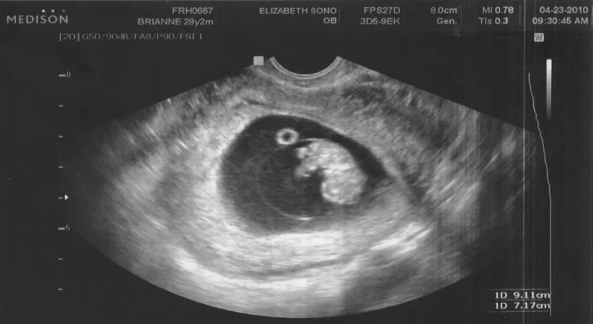 Фото УЗИ. 