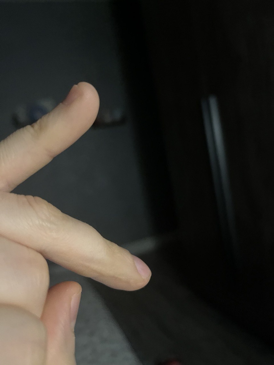 Все зажило: на память лишь остались эти два уродливых пальца и шрам