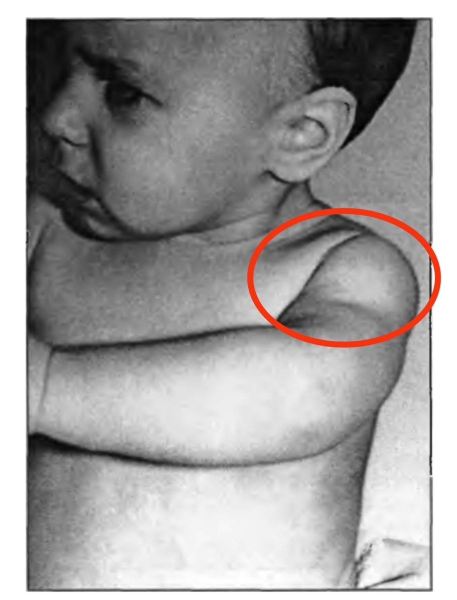 Симптом "кукольной ручки" Новика: ручка кажется приставленной к туловищу и отделяется от него глубокой складкой