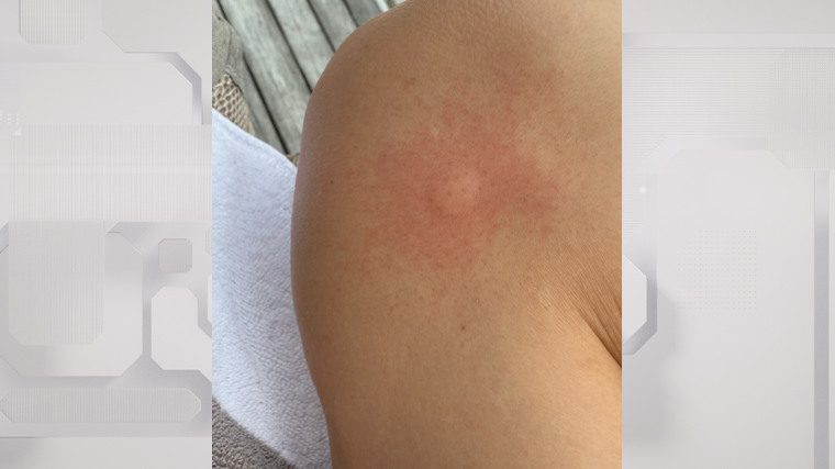    Певицу Славу покусали постельные клопы. Instagram*/nastya_slava