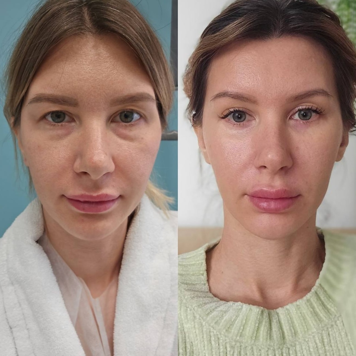 Что было выполнено? Эндоскопический лифтинг лба (это позволило избежать разрезов на верхних веках), а также нижняя пластика век с распределением грыжевых мешков и липофилинг слезных борозд
