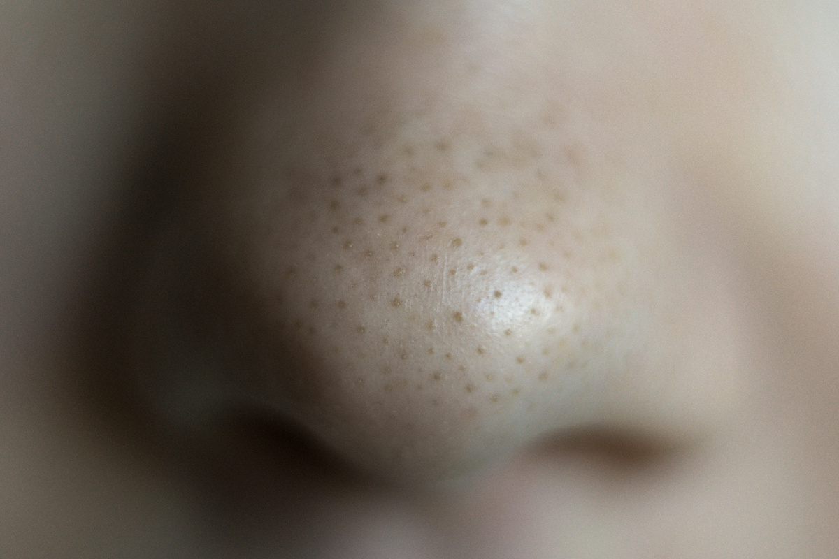 Черные точки на носу