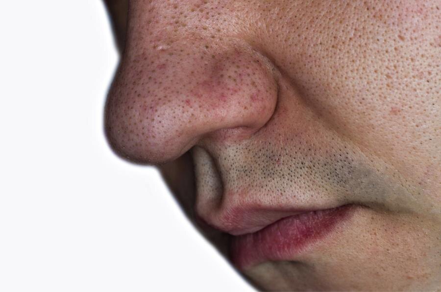 Черные точки на лице и носу