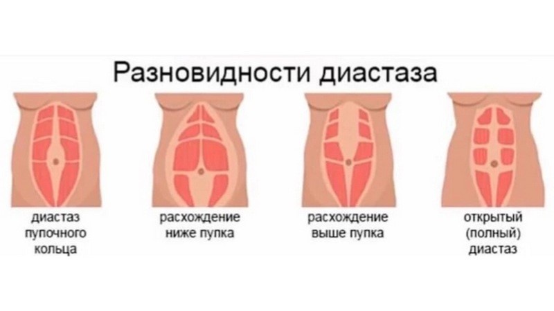 Разновидности диастаза