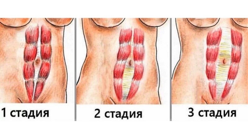 Стадии диастаза