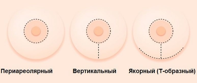 Варианты надрезов при мастопексии
