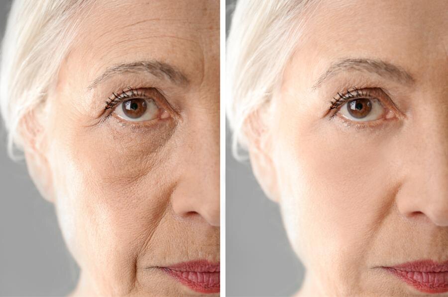 Эффект от биоревитализации