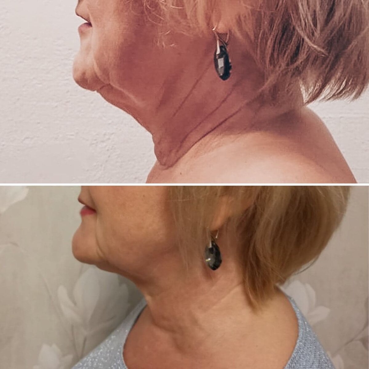 Результаты ученицы курса "Красивое лицо и здоровое тело"