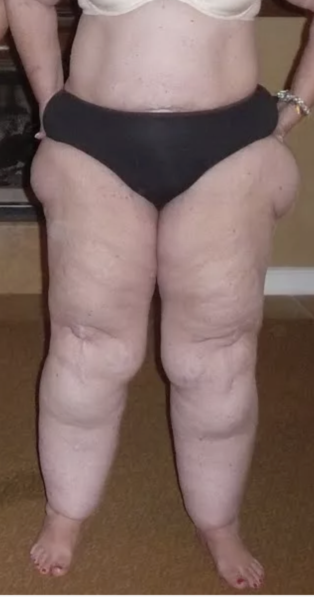 Ткани обводнены, щиколотки скрыты, как будто человек в налитых водой штанах из собственной кожи.