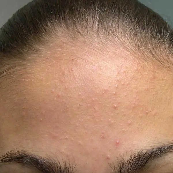 Комедональное акне