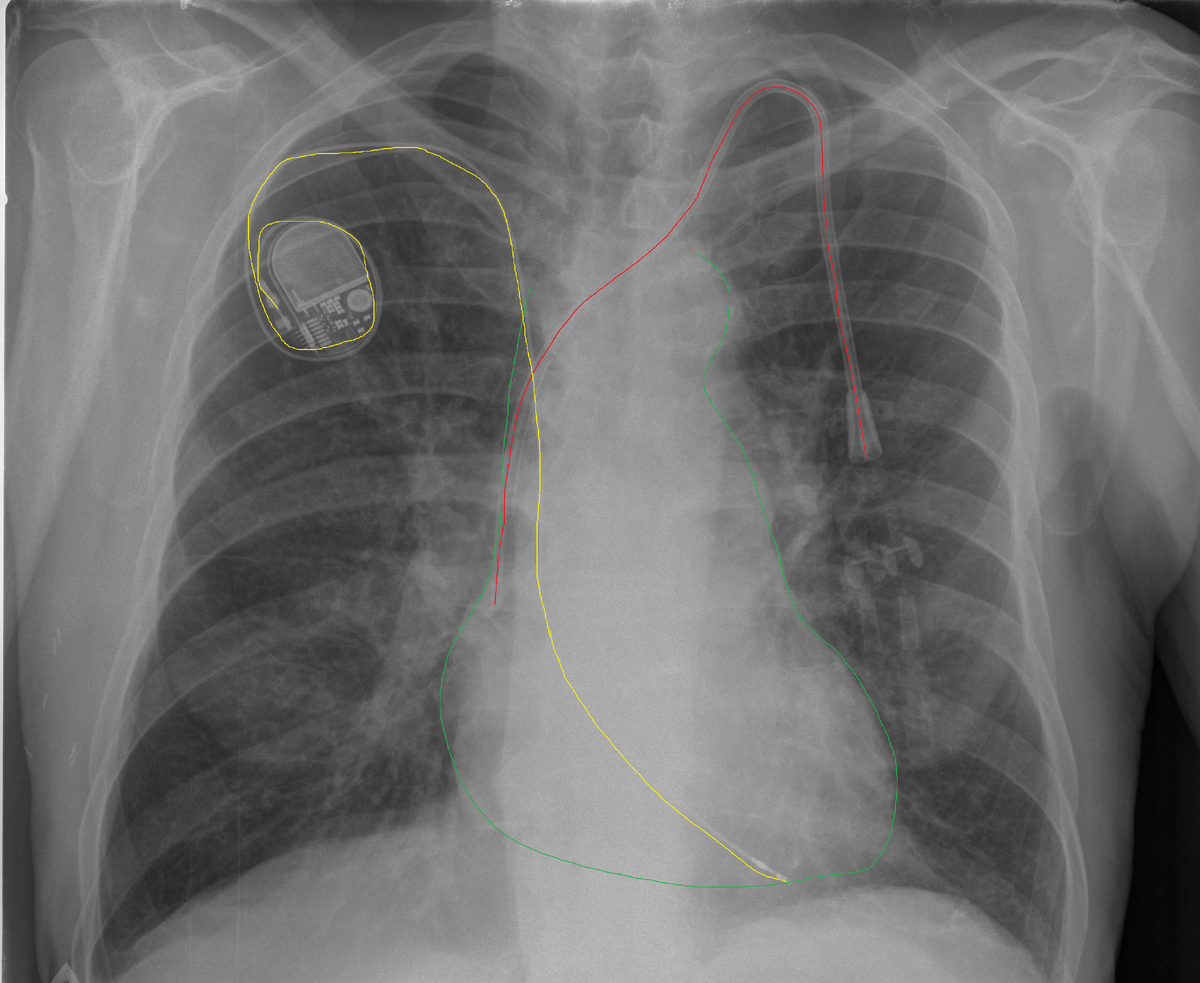 ЭКС - желтый, диализный катетер красный в левой подключичной вене, дистальный конец в проекции границы верхней полой вены и правого предсердия