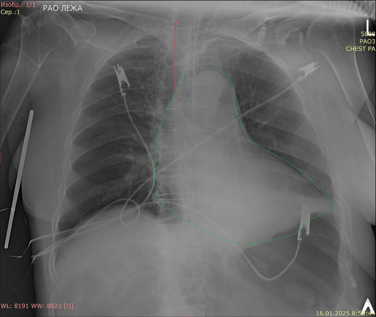 ЦВК справа (вену определить невозможно), дистальный конец в проекции верхней полой вены