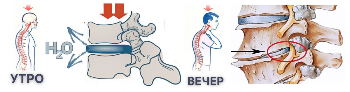 Состояние межпозвонковых дисков утром и вечером.