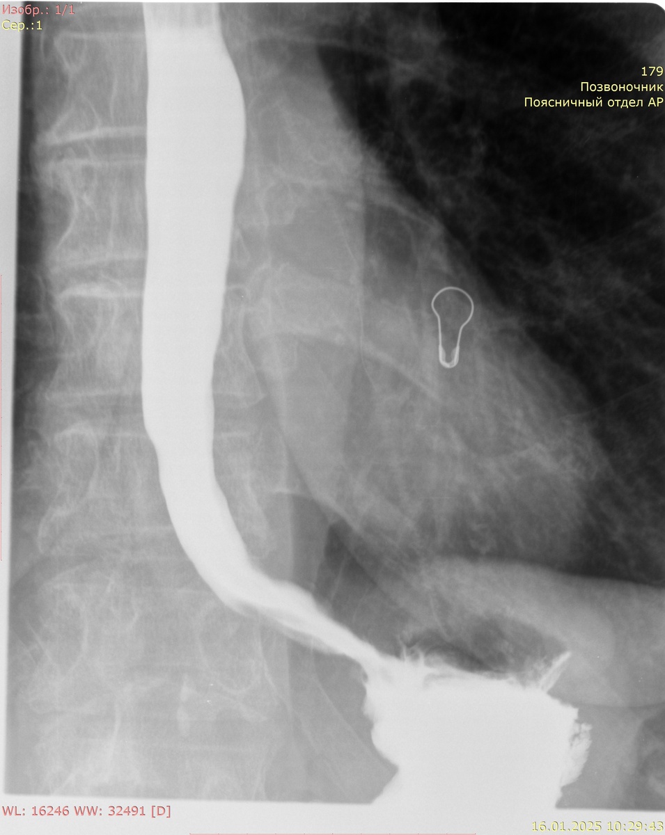 Пищевод и вход в желудок (кардия)