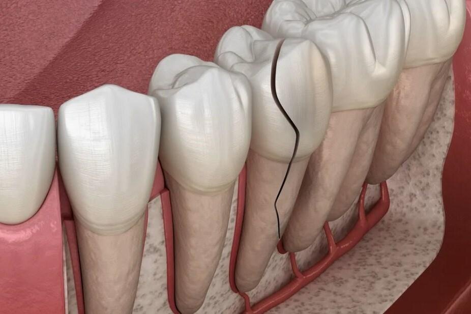 Трещина корня зуба