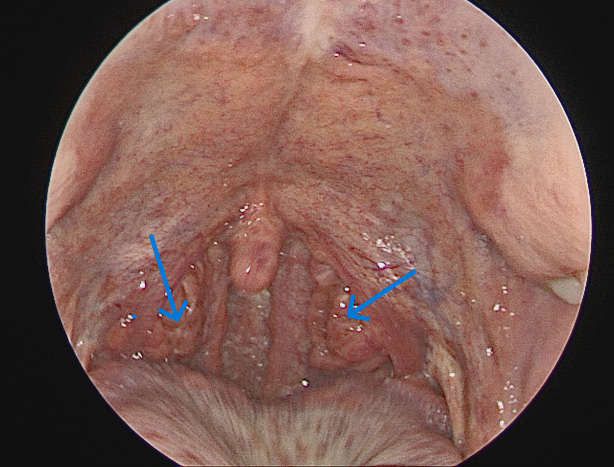 Небные миндалины находятся по бокам глотки. При хроническом воспалении они краснеют, рубцово изменяются и могут содержать белые пробки или гной. Расположенные рядом небные дужки и участки задней стенки глотки обычно тоже краснеют.