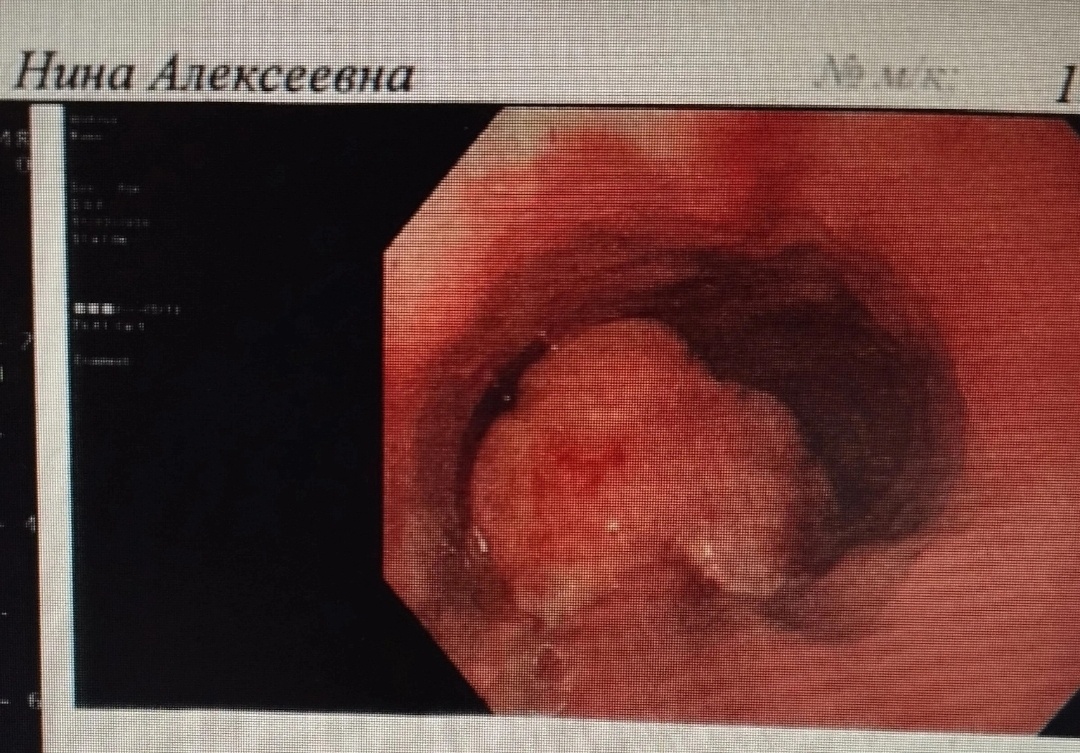 Так выглядел мой рак на Эндоузи в НМИЦ им. Алмазова в г. Санкт-Петербурге. Февраль 2020 года. Фото из архива автора 