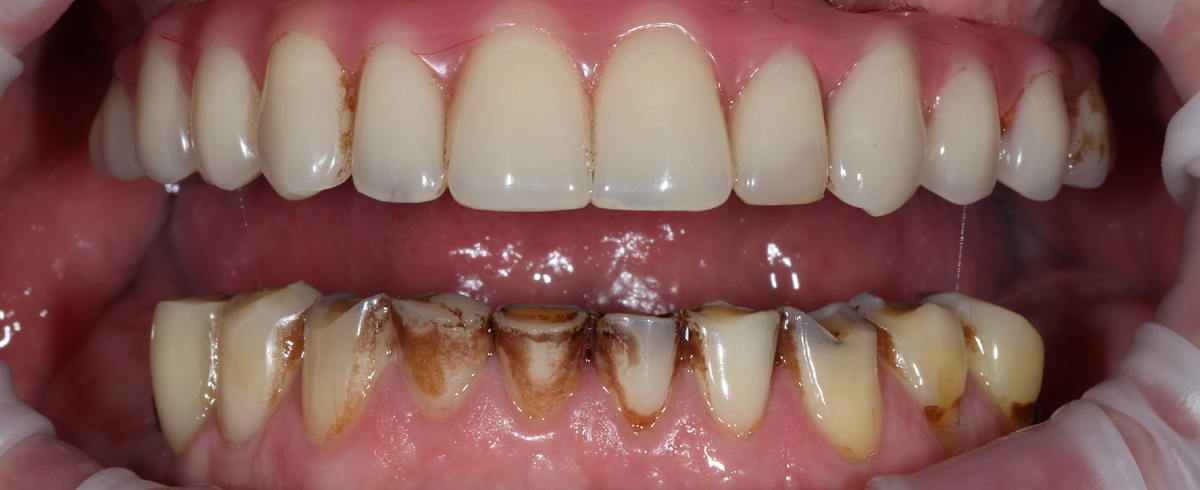 Пациент клиники ПРАЙМ со стираемостью нижних зубов (фото до установки виниров).